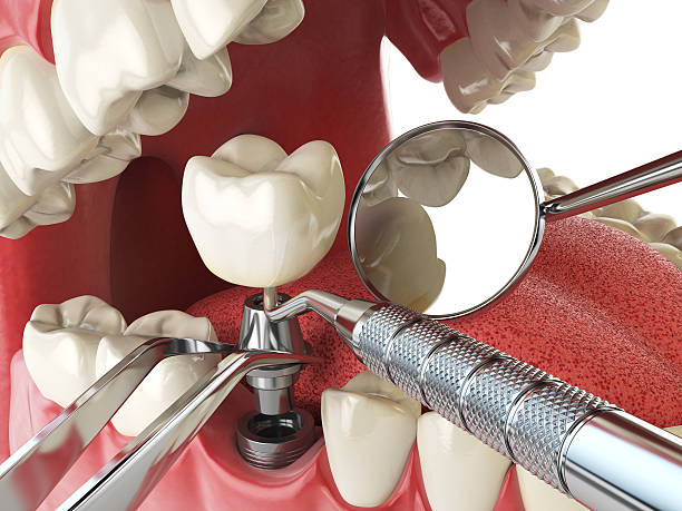 Best Chipped Tooth Repair Near Me  in Troy, NC